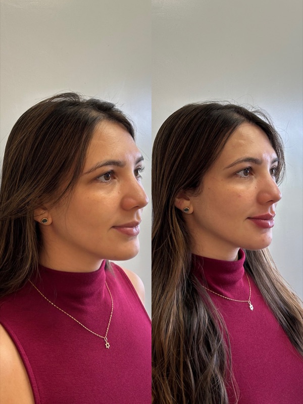 Comparativo de antes e depois de harmonização facial em perfil, apresentado na publicação original